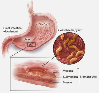 Illustration for article titled Obat Maag Cepat Sembuh